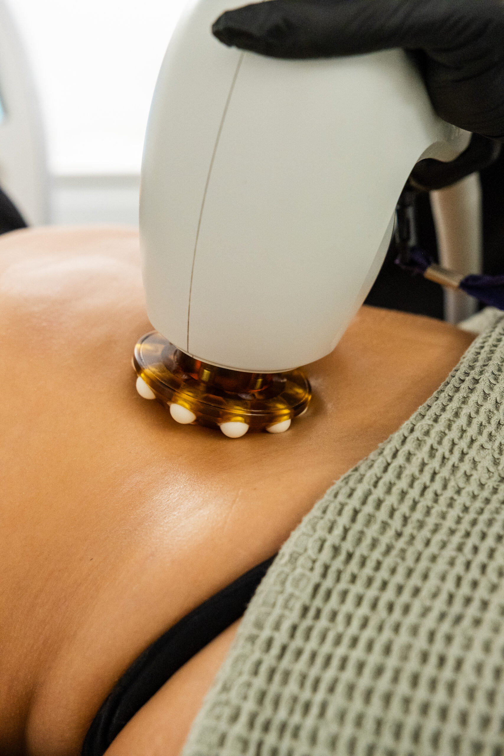 oliva clinics mesoterapia corporal